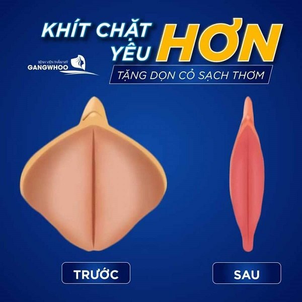 thu hẹp vùng kín